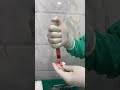 Fat Grafting Procedure [Part 6] | How Fat is Prepared for Injection | Dr. Arun Panda