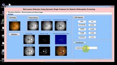 Red Lesion Detection Using Dynamic Shape Features for Diabetic Retinopathy Screening