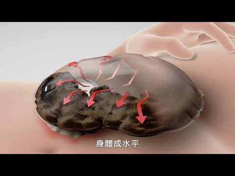 康樂保 Coloplast - 造口護理之 pancaking effect - 班戟效應