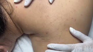 Stubborn Back Acne – Harder Than You Think