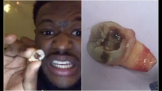 DC Young Fly Pulls Out Tooth Shows How Rotten It Was