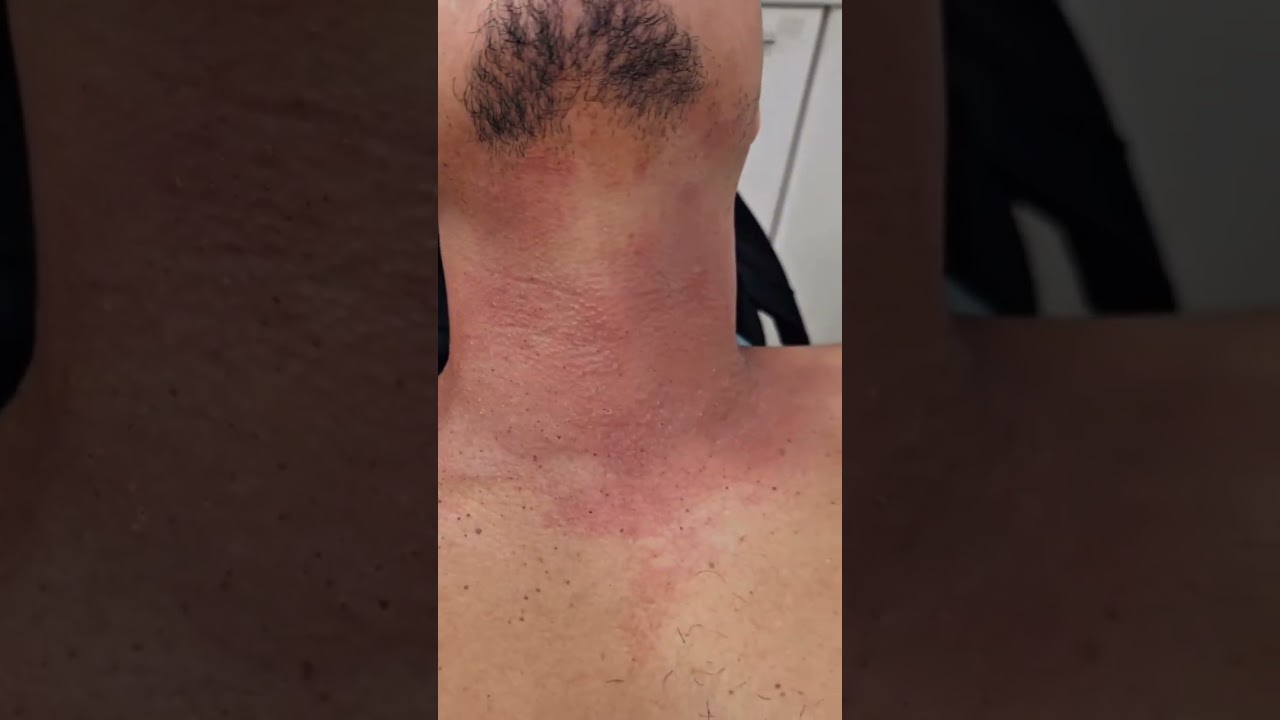 Plasma IQ - Adeus rugas e flacidez  #dermatologista