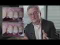 Step-by-step class V restorations-flow or conventional composite [EN]