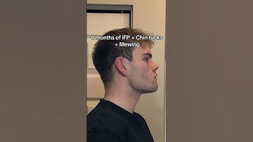 How I achieved forward growth at 18 #glowup #looksmaxxing #faceexercise