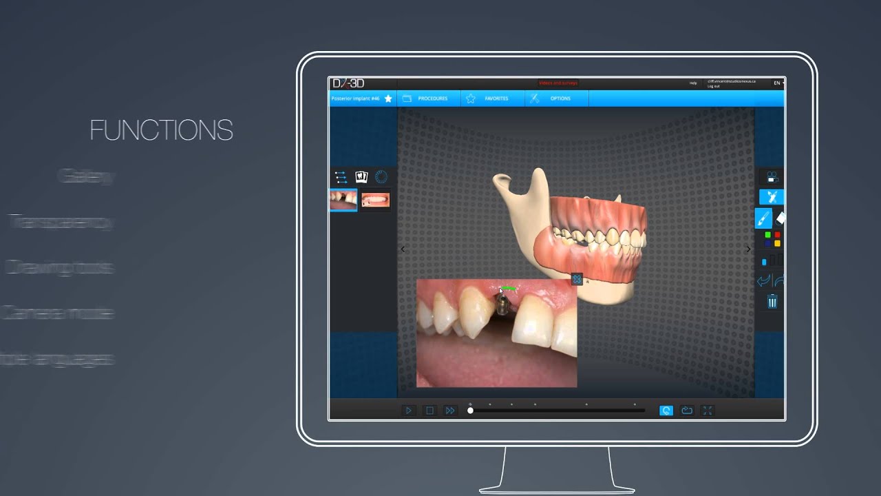 ShowplanDX Dental procedures with 3D interactive model for treatment and consultation room