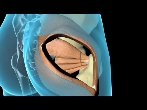 Video: Reduserer Lokal Infiltrasjonsanalgesi Peri-operativ Betennelse Etter Total Hoftearthroplastikk? En Randomisert, Dobbeltblind Studie