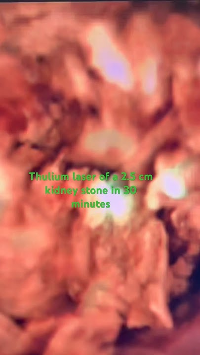 Thulium Laser Of A 2 5 Cm Kidney Stone In 30 Minutes YouTube thulium-laser-of-a-2-5-cm-kidney-stone-in-30-minutes-youtube