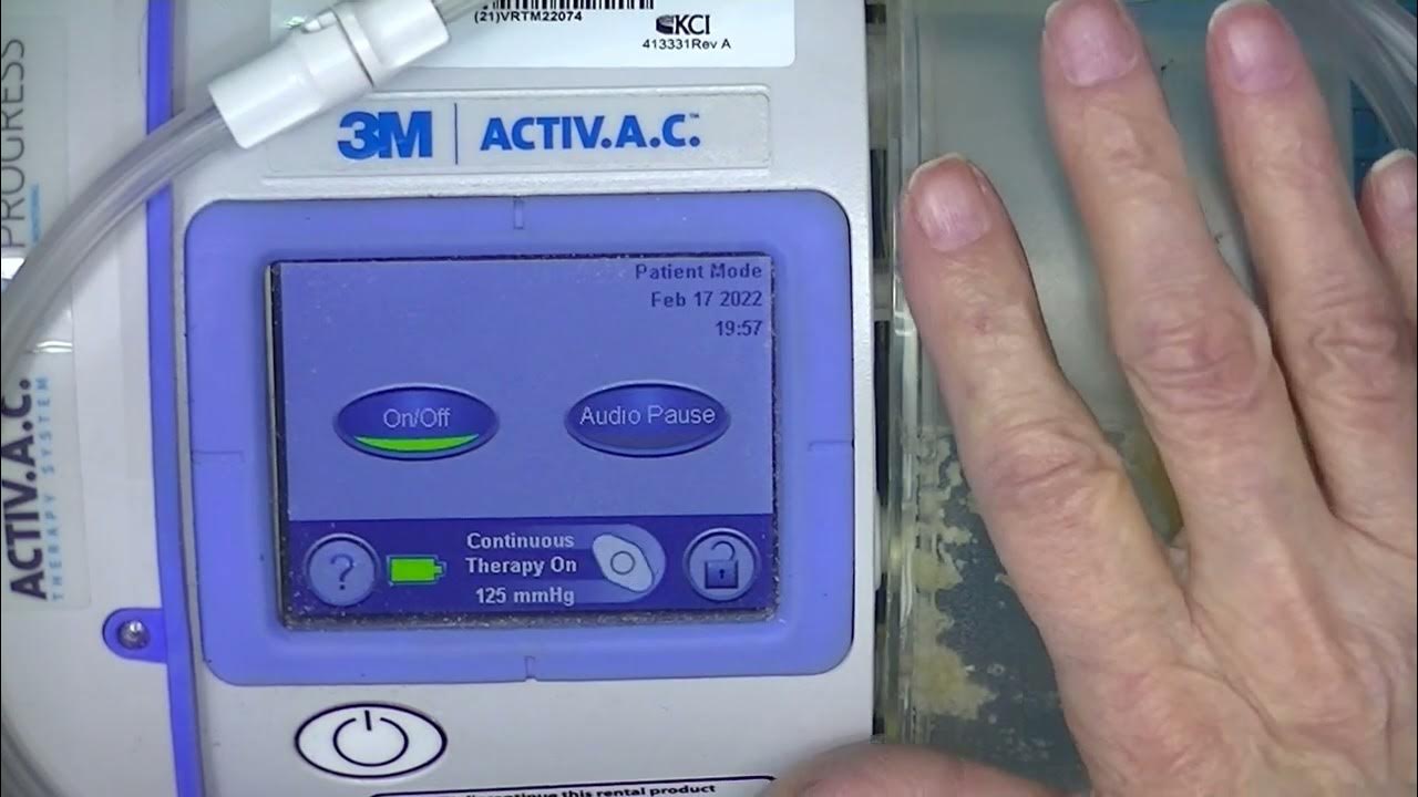 A Quick Look at the Wound Vac System YouTube