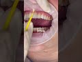 Porcelain veneers before and after  porcelain veneers procedure  dr yazdan  dental veneers