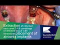 Extraction of Infected Root Canal & Placement of Zirconia Implant