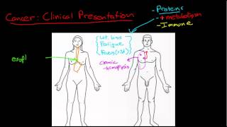 Cancer: Clinical Presentation