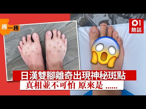 日男腳背驚現神秘斑點　一度擔心染怪病　真相笑翻網民｜01熱話