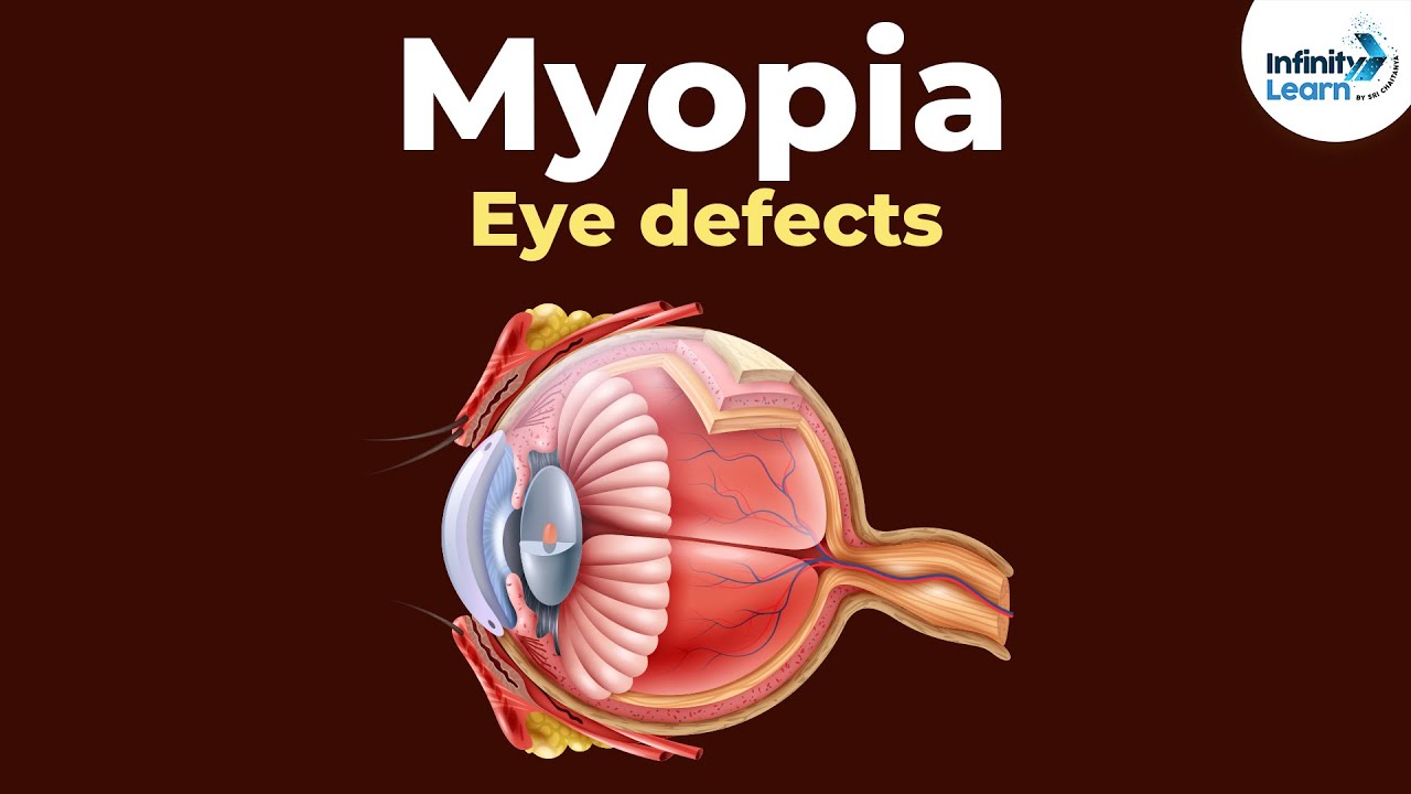 örökletes myopia kezelésére