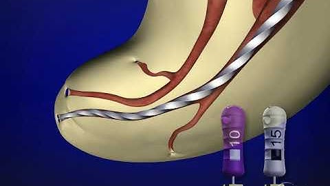 Shape Clean Pack: Glide Path Management - Irregular Glidepath: Dr. Ruddle Advanced Endodontics