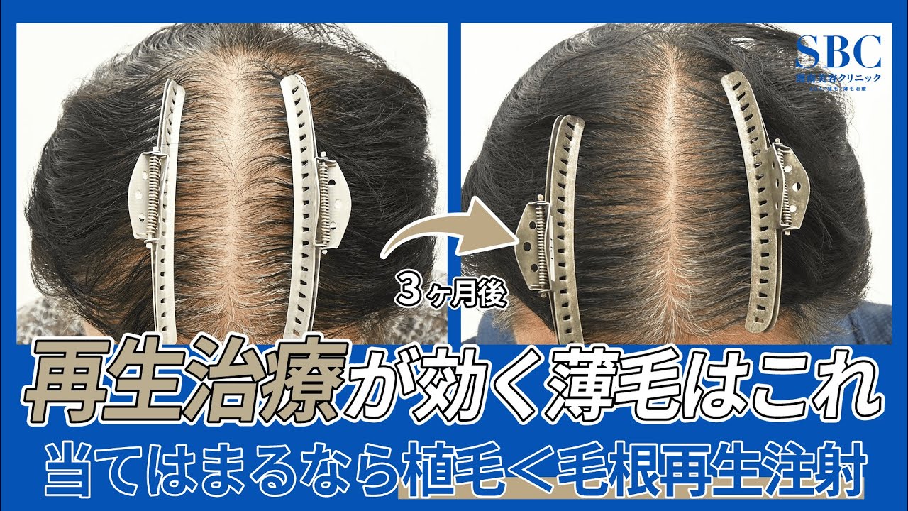 植毛より毛根再生注射が効果的な薄毛はコレ！ヒントは【適応】