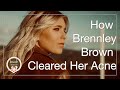 How country singer Brennley Brown Cleared her acne with virtual consultations