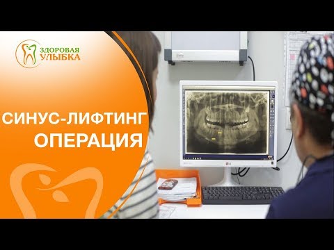 Синус лифтинг операция. 💉 Безболезненный и эффективный метод операции синус лифтинга.