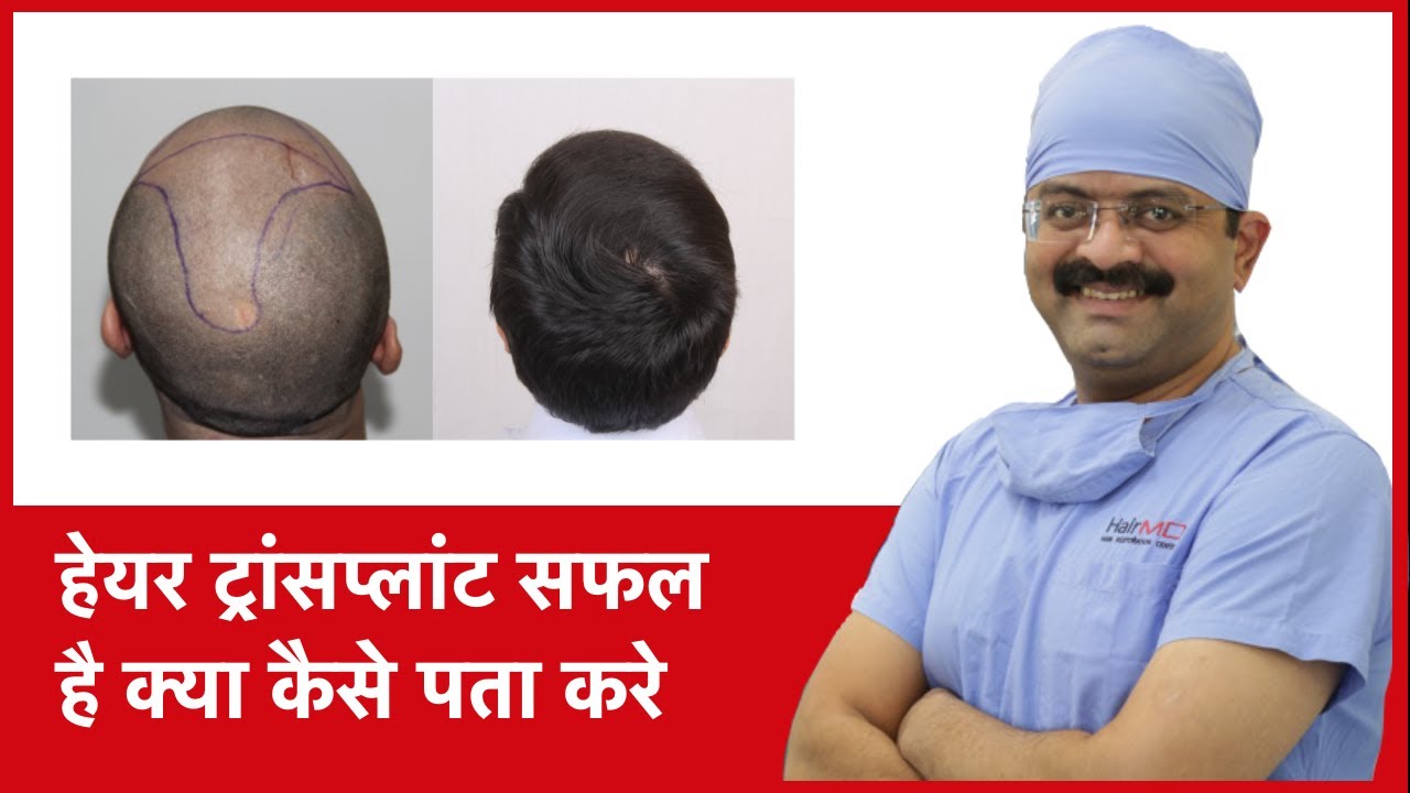 How To Know Hair Transplant Is Successful (हेयर ट्रांसप्लांट सफल है क्या  कैसे पता करे) | (In HINDI) - YouTube