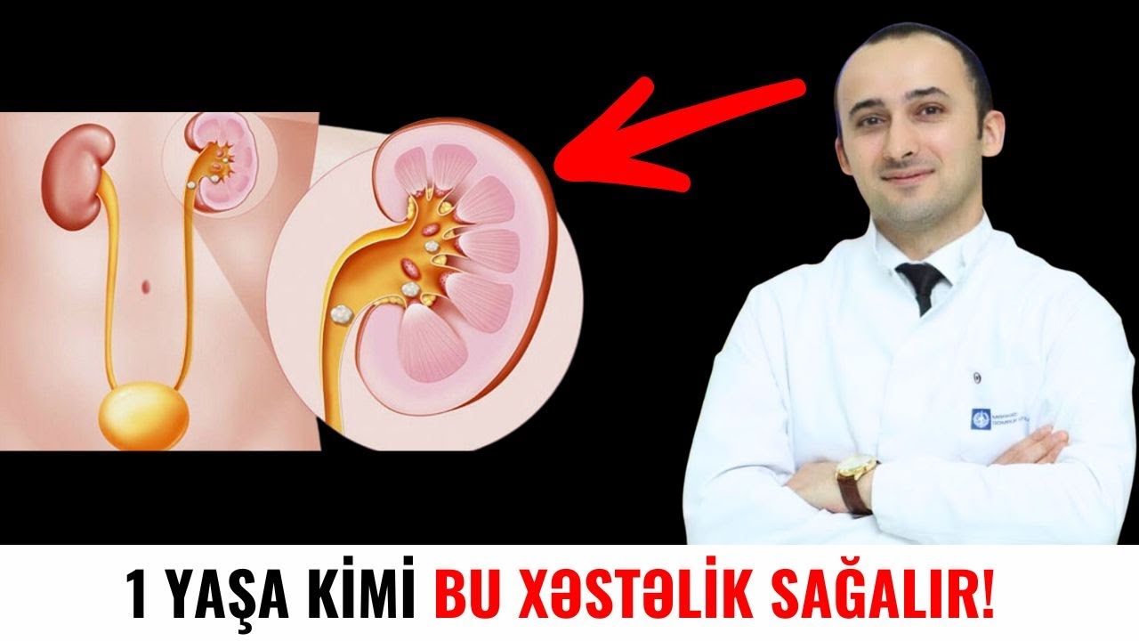 1 Yaşa kimi bu XƏSTƏLİK SAĞALIR - Hidronefroz