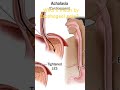 What is Esophageal Pain? Causes, Symptoms &amp; Treatment Explained | Acid Reflux &amp; GERD