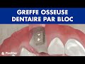 Greffe osseuse dentaire par bloc ©