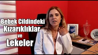 Bebek Cildindeki Kızarıklıklar Ve Lekeler