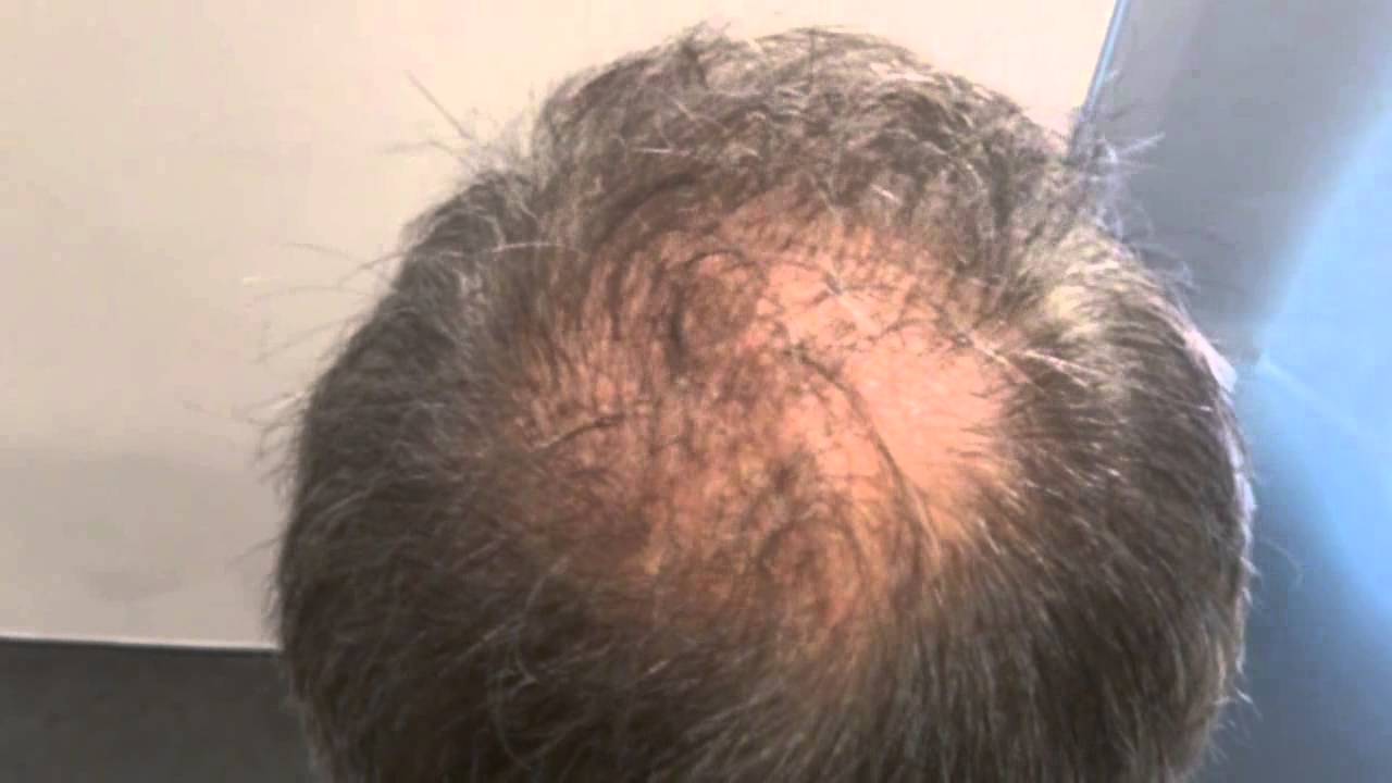 Scalp Micro pigmentation result prohairclinic - YouTube