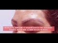Eyebrow Transplant Surgery | The Full Procedure | The Brow Lift By Maloy
