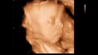 3D Ultrasound Canada - 3D Sono IMAGE - BABY 29 WEEKS