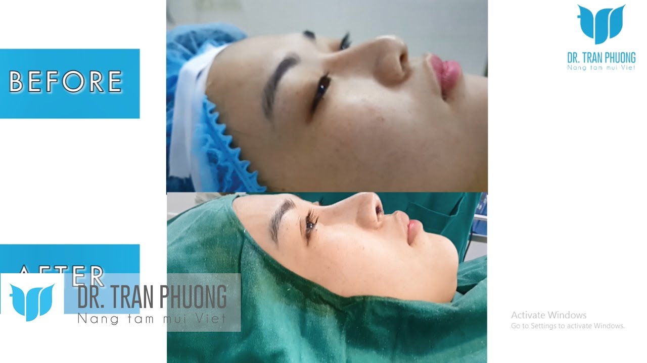 Bác sĩ Trần Phương: Khách hàng trước và sau nâng mũi Cấu Trúc