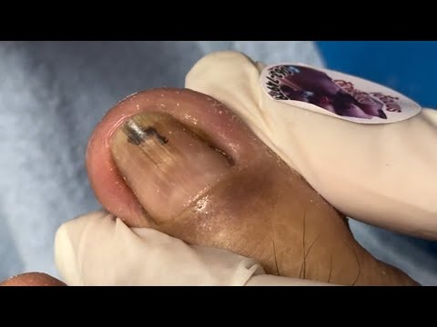 Ep_6657 Ingrown toenail removal 👣 พี่รู้แล้ว..ทำไมถึงเจ็บมาก 😄 (clip from Thailand)