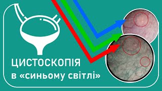 Цистоскопія в СИНЬОМУ світлі -  сучасна діагностика раку сечового міхура (ЯК ЦЕ ПРАЦЮЄ)