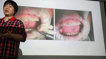 VENEER- Từ lâm sàng đến lab 2