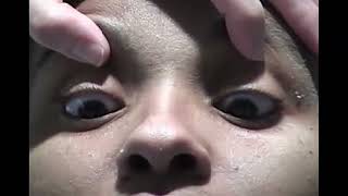 Video 15 5 Ocular Bobbing