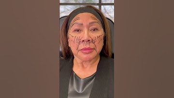 Thread lift 🥰 I am using NovaThreads PDO threads 🪡 To reposition the superficial fat pads 🤗