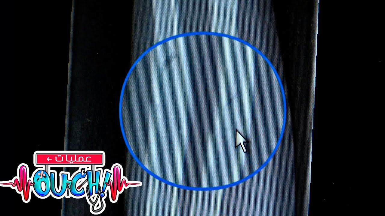 أوبريشن آوتش - معالجة العظام المكسورة | العلوم للأطفال