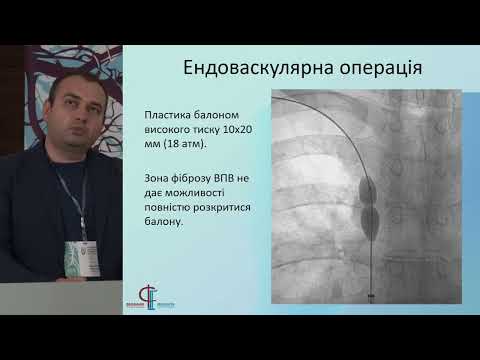 Ендоваскулярне лікування катетер асоційованої оклюзії верхньої порожнистої вени.  Денисов С.