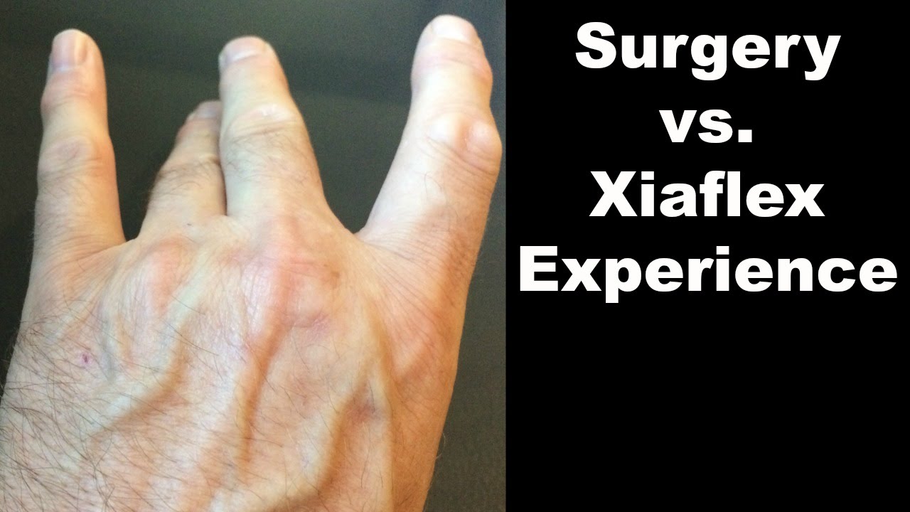 What is Dupuytren's contracture?