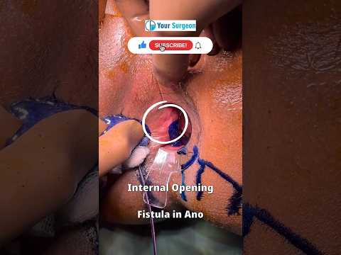 Fistula In ANO ? How it Looks ?? Video & photos I bhagandar ? Pics of Fistula I Images