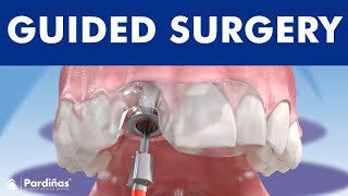 Guided implant surgery ©