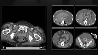 Emergent Complications of Hepatic Cirrhosis |  Interesting Radiology Cases