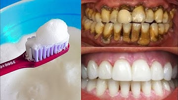 3 cách làm trắng răng bị ố vàng sau 1 đêm, răng xỉn màu ố vàng mấy cũng trắng bóc