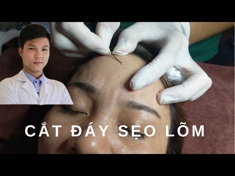 Trị sẹo rỗ:Cắt đáy sẹo bằng kim tiêm thường| cách trị sẹo lõm| Dr Ninh.