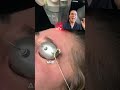 Best Laser for Acne Scars