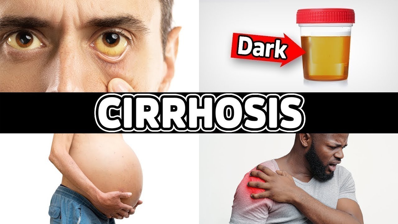 7 Warning Signs Of Cirrhosis End Stage Liver Disease Dr Berg YouTube 7 Warning Signs Of Cirrhosis End Stage Liver Disease Dr Berg YouTube