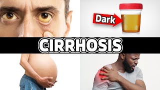 7 Warning Signs of Cirrhosis (EndStage Liver Disease)  Dr. Berg