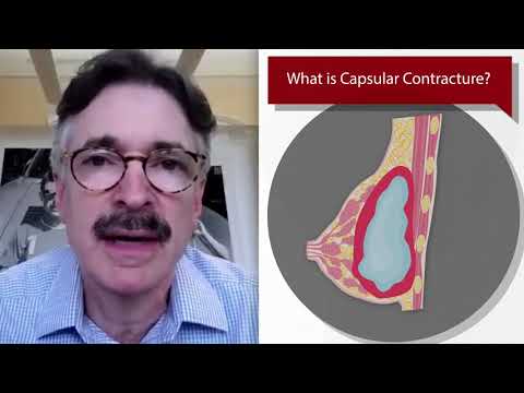 Ways to Treat Capsular Contracture. Plastic Surgery Hot Topics - Drs. Rohrich, Hidalgo, & Weinstein