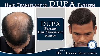 DUPA Pattern HairTransplant Result| Grade 6 Baldness | Patient Review | Hair Transplant Clinic Surat