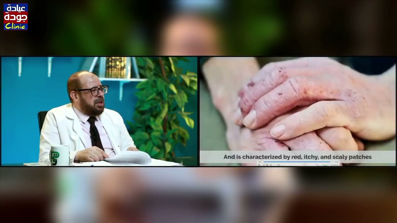 علاجات الاجزيما والهرش  | دكتور جودة محمد عواد