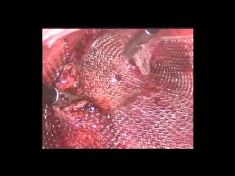 Laparoscopic Prolapse Surgery by Dr. Nikita Trehan